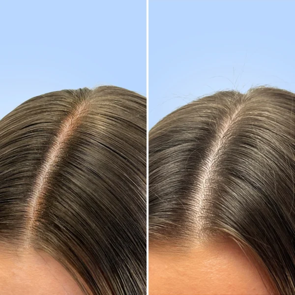 Clarifying Shampoo - Απολεπιστικό Σαμπούαν Σαλικυλικό Οξύ 250ml - Image 6
